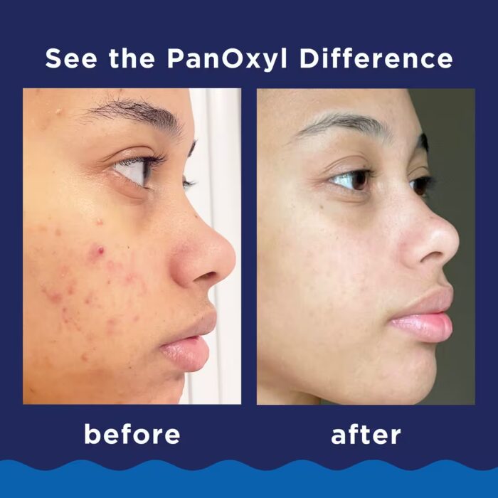 PanOxyl Acne Foaming Wash with 10% Benzoyl Peroxide (156g) - Image 5