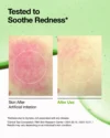 Anua Azelaic Acid 10 Hyaluron Redness Soothing Serum (30mL) - Image 5
