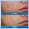 CeraVe Acne Foaming Cream Wash (150mL) - Image 3