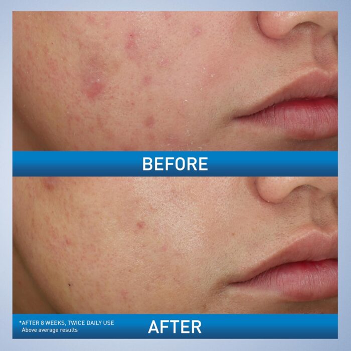 CeraVe Acne Foaming Cream Wash (150mL) - Image 3