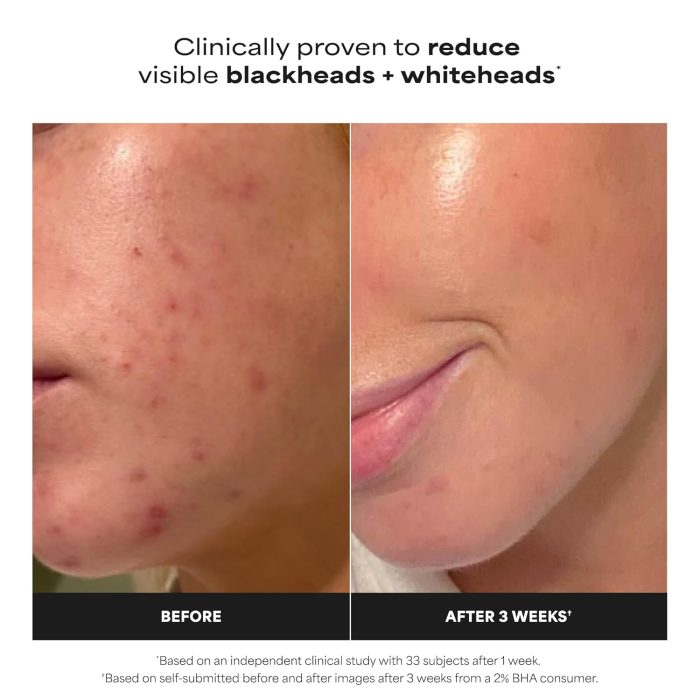 Paula's Choice Skin Perfecting 2% BHA Liquid Exfoliant Travel Size (30mL) - Image 2
