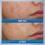 CeraVe Acne Foaming Cream Wash with 10% Benzoyl Peroxide Acne Treatment (150mL) - Image 3