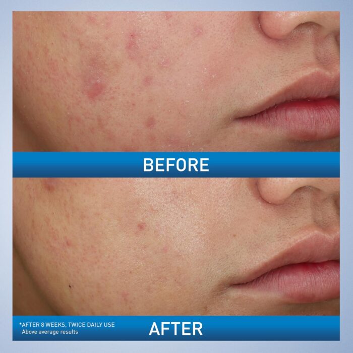 CeraVe Acne Foaming Cream Wash with 10% Benzoyl Peroxide Acne Treatment (150mL) - Image 3