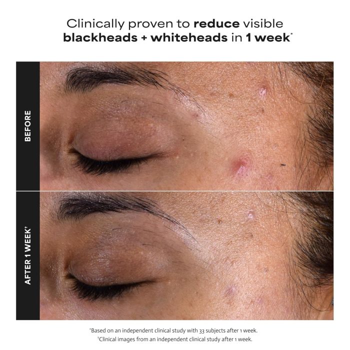 Paula's Choice Skin Perfecting 2% BHA Liquid Exfoliant Travel Size (30mL) - Image 4