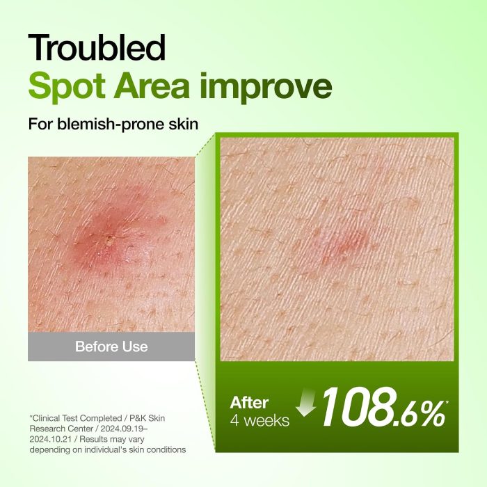 Anua Azelaic Acid 10 Hyaluron Redness Soothing Serum (30mL) - Image 5