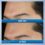 CeraVe Acne Foaming Cream Wash with 10% Benzoyl Peroxide Acne Treatment (150mL) - Image 4